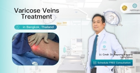 Varicose Veins Treatment in bangkok