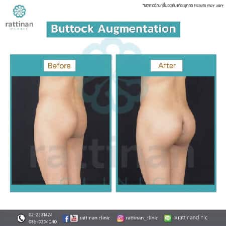 buttock augmentation without scars no pain and inexpensive