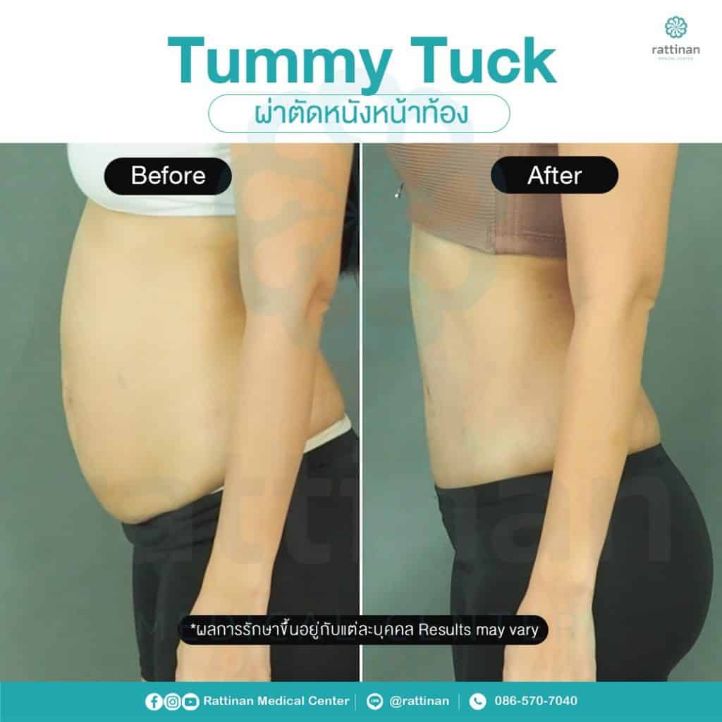 Abdominoplasty : How to find The Best Tummy Tuck in Thailand