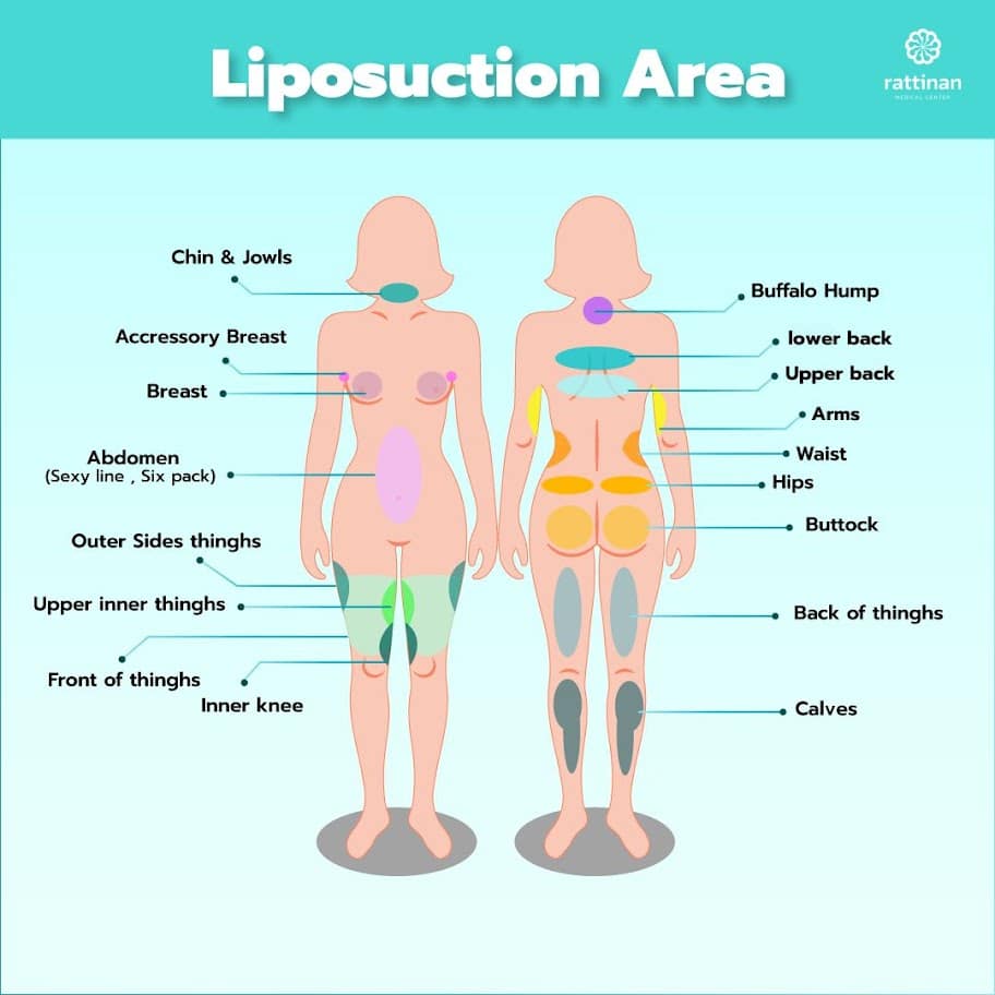 Liposuction treatable area