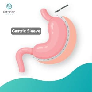 Gastric Sleeve surgery