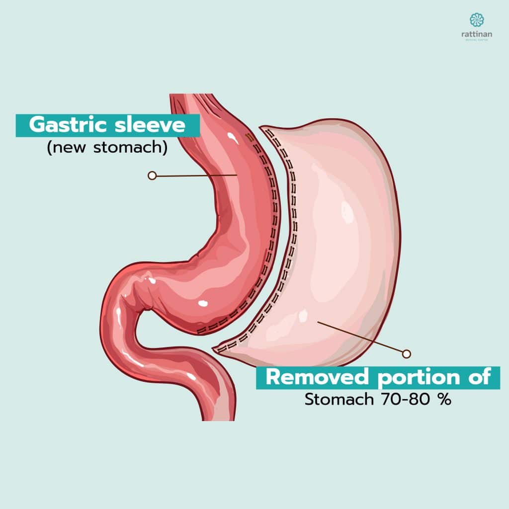 Gastric sleeve