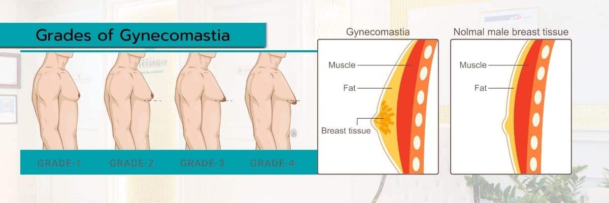 Gynecomastia Surgery in Thailand grades