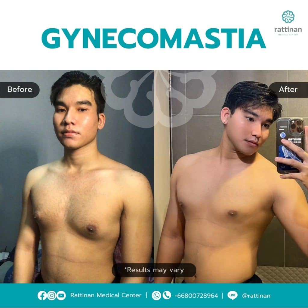 How Much Does Gyno Surgery Cost in Bangkok? | Rattinan Medical Center