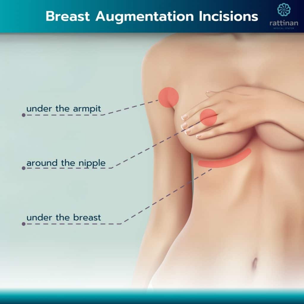 Breast Augmentation Incisions