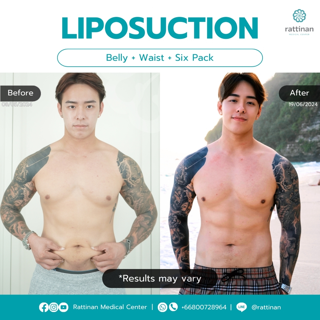 Liposuction in Thailand review