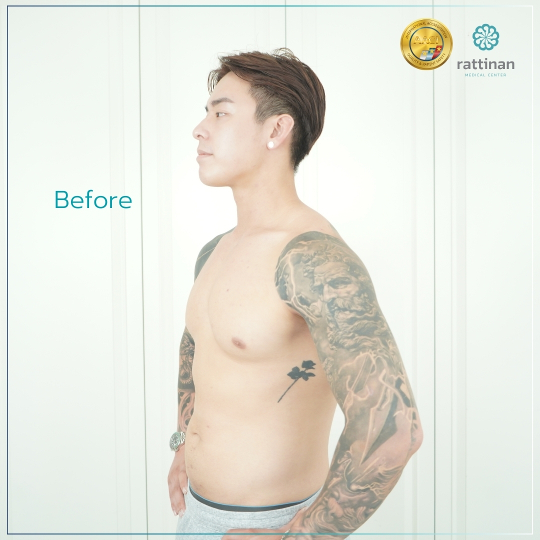 liposuction Thailand review by Titus