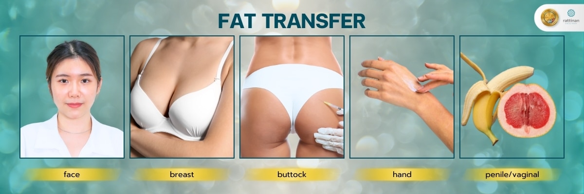 area for fat transfer