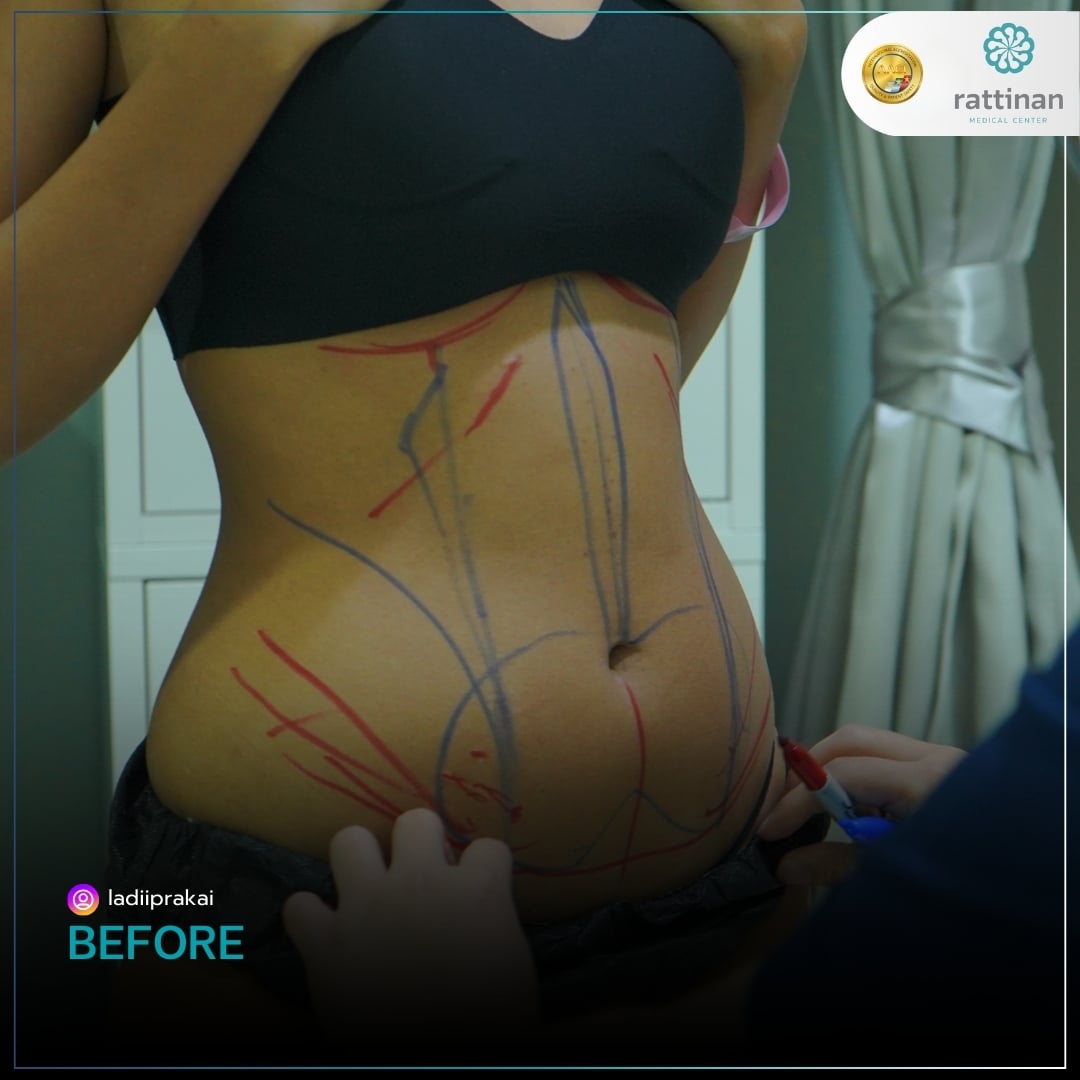 bangkok liposuction reviews Prakai Before 1