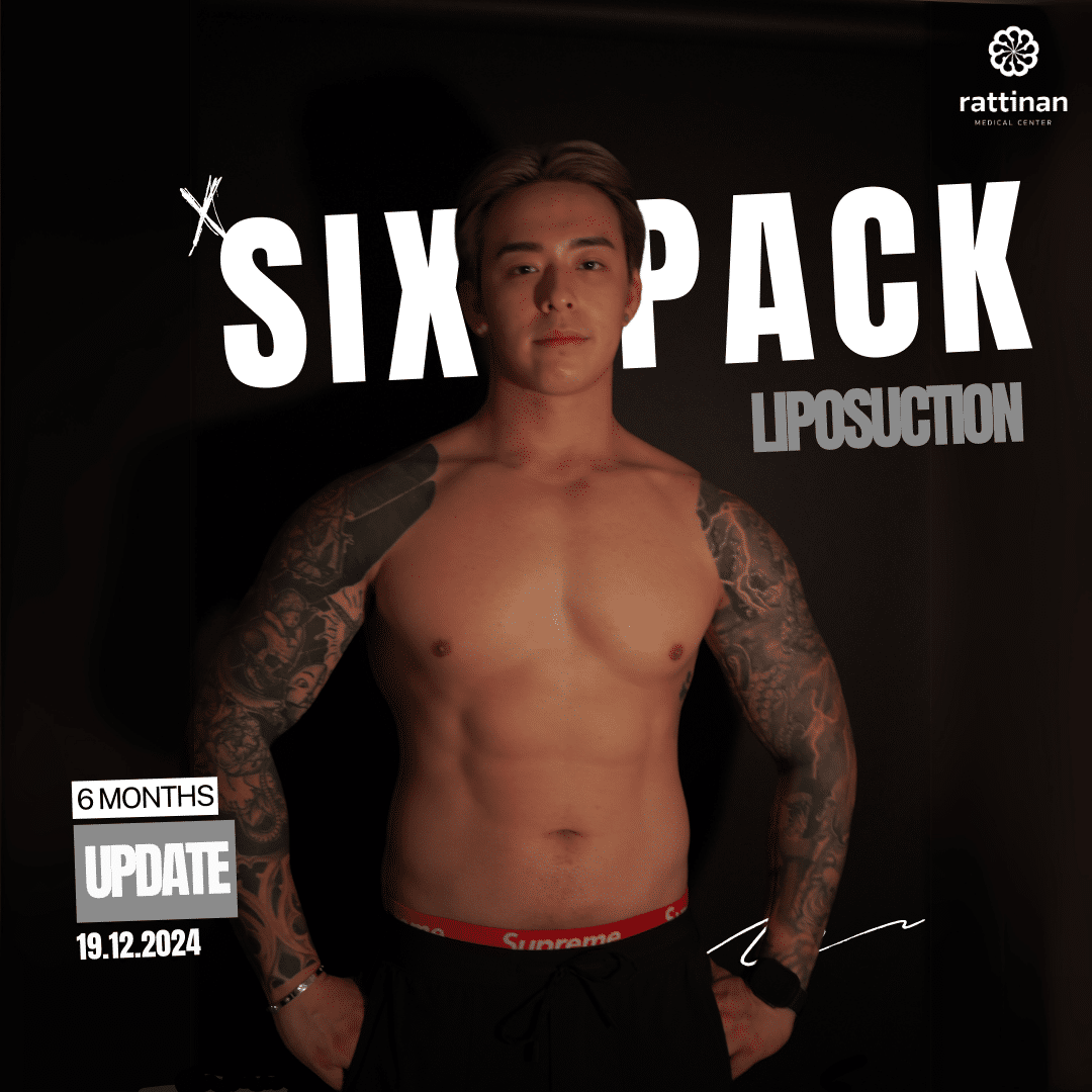 Titus Low Six pack