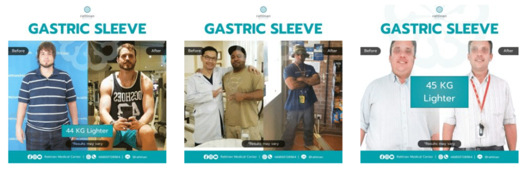 Gastric Sleeve