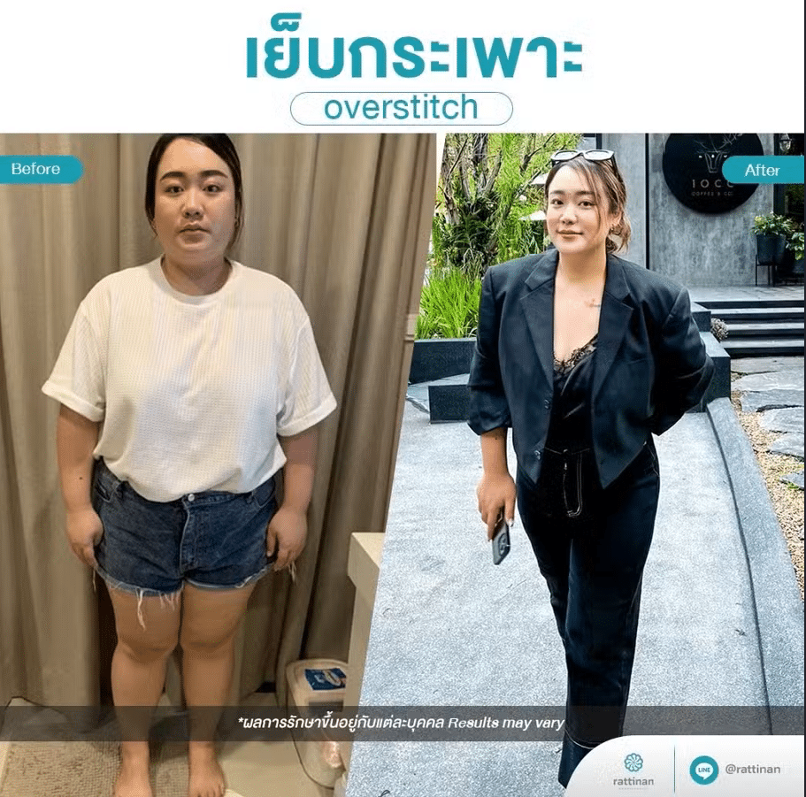 Overstitch Surgery in Thailand Has Changed Her Life