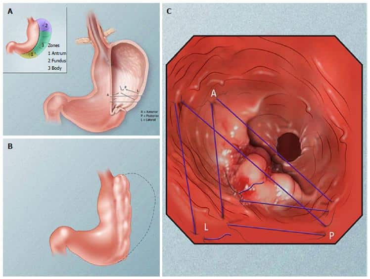 What Is OverStitch or Endoscopic Sleeve Gastroplasty