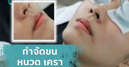 เลเซอร์กำจัดขน laser hair removal