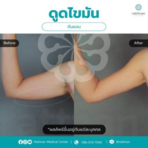 ดูดไขมันต้นแขน ภาพรีวิว 3