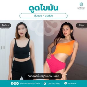 ดูดไขมันต้นแขน ภาพรีวิว 9