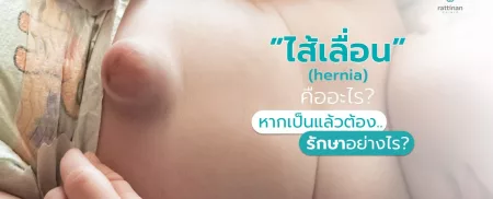 ไส้เลื่อน คืออะไร