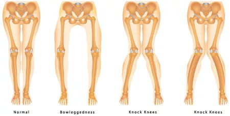 knock knees ขาโก่ง ขาฉิ่ง