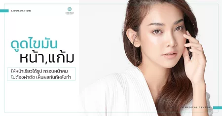 ดูดไขมันหน้า แก้ม bodyTite + microAire PAL