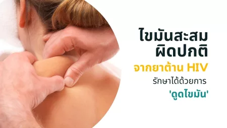 ยาต้าน HIV ทำให้เกิดไขมันสะสมผิดปกติ รักษาได้ด้วย การดูดไขมัน