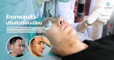 รักษาหลุมสิว ด้วย Pico Laser