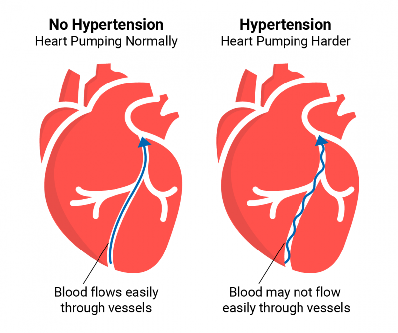 ความดันโลหิตสูง (Hypertension) โรคยอดฮิตของคนอ้วน