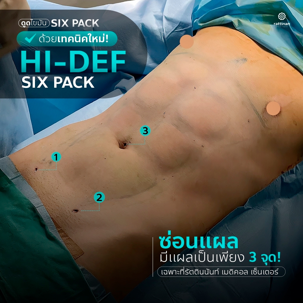 ดูดไขมันเทคนิค Hi-Def Six Pack แผลป็น 3 จุด