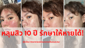 หลุมสิว 10 ปี