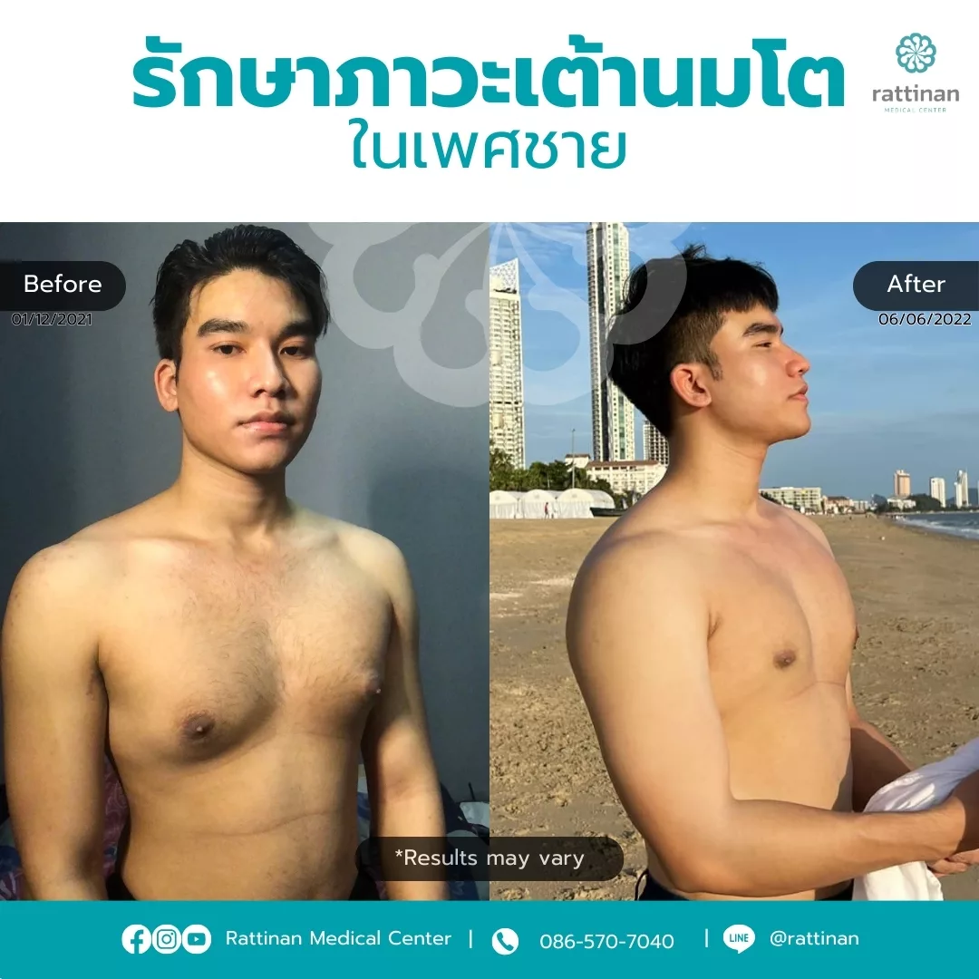 รีวิวการลดนมผู้ชาย