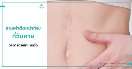 แผลผ่าตัดหน้าท้อง กี่วันหาย