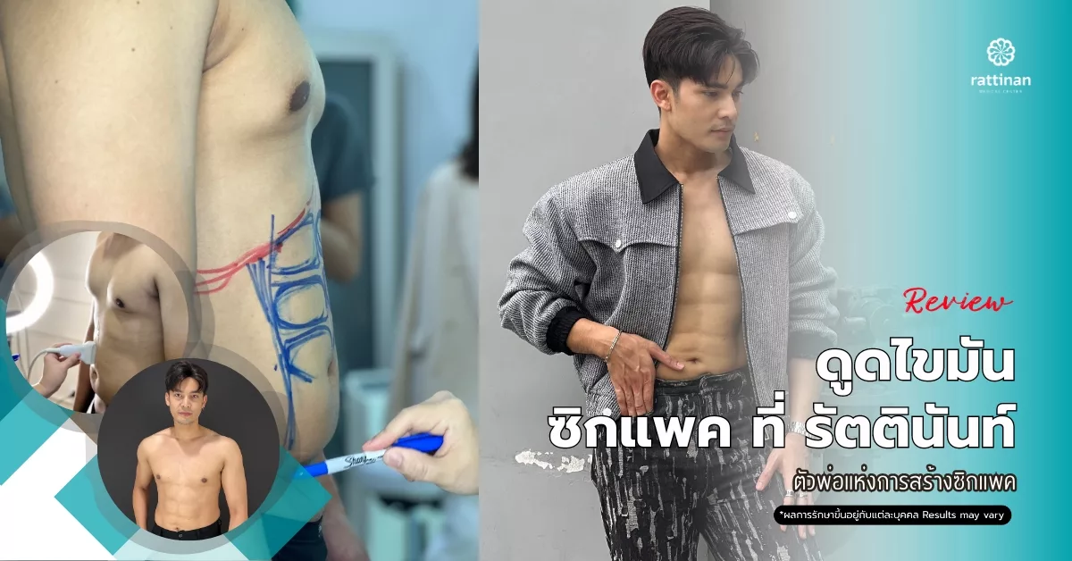 รีวิว ดูดไขมันซิกแพค