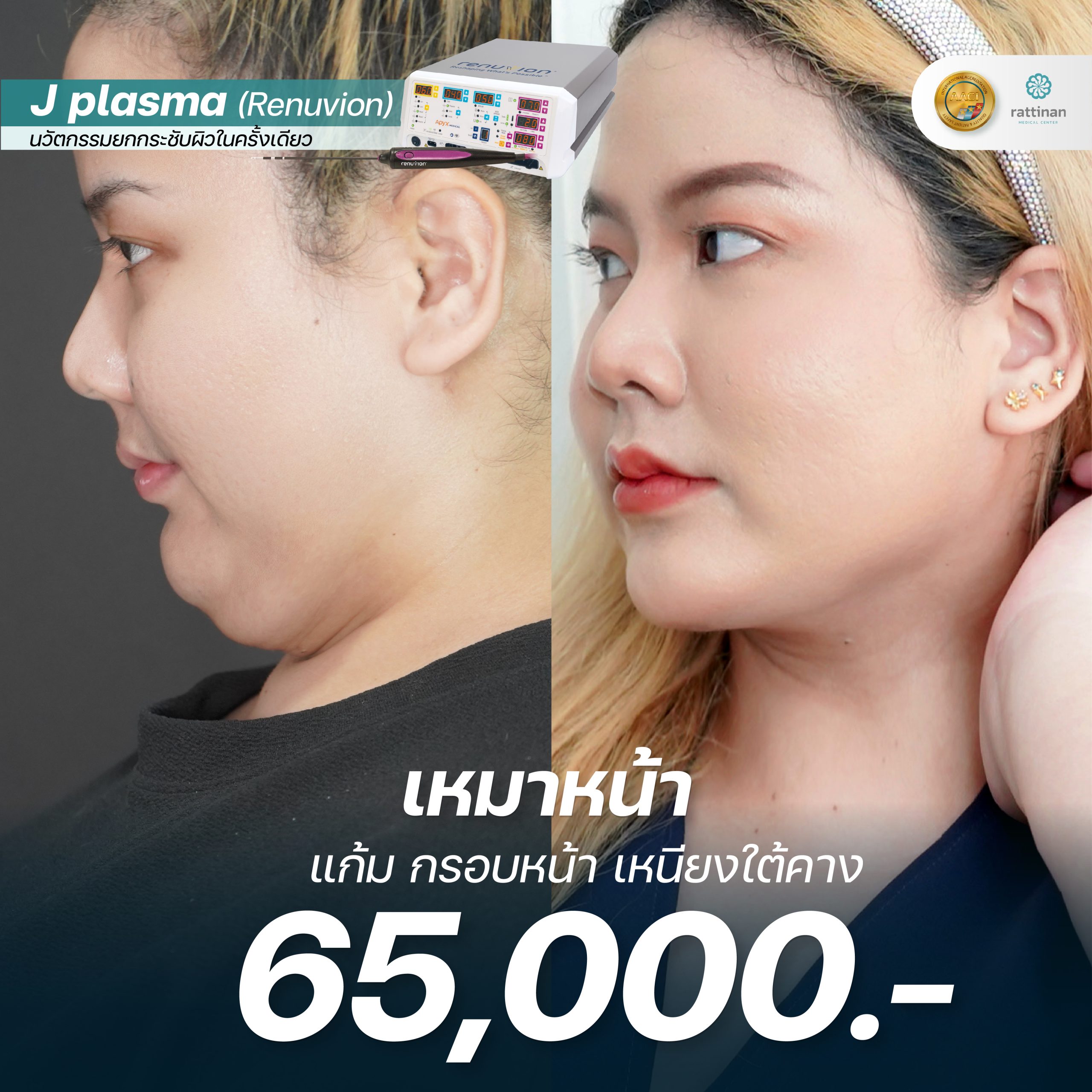 J Plasma ราคาที่รัตตินันท์