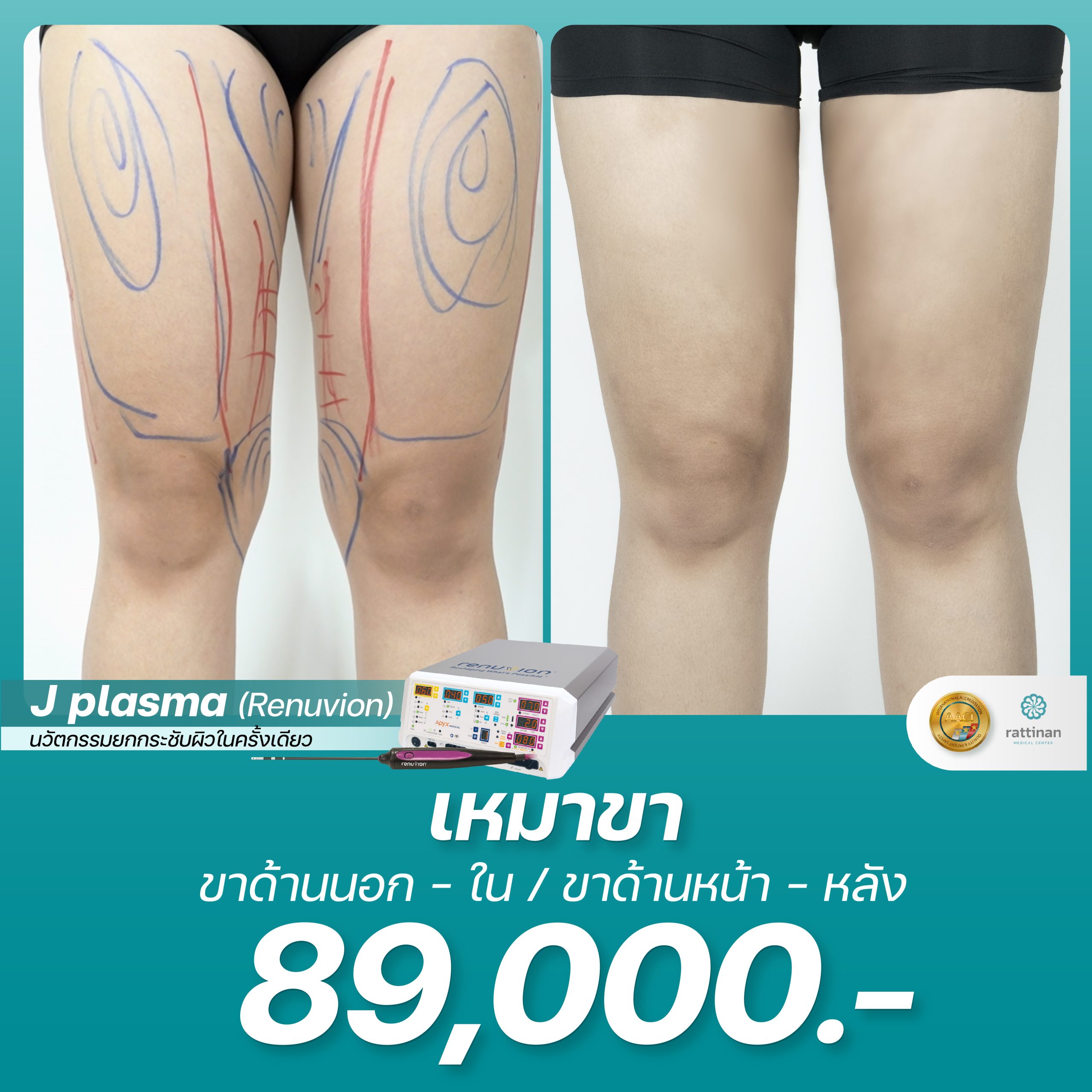 J Plasma ราคา