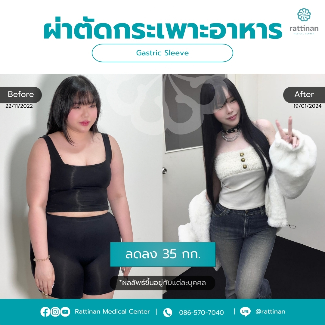 ผ่าตัดกระเพาะ รีวิว Gastric sleeve Before & After 08