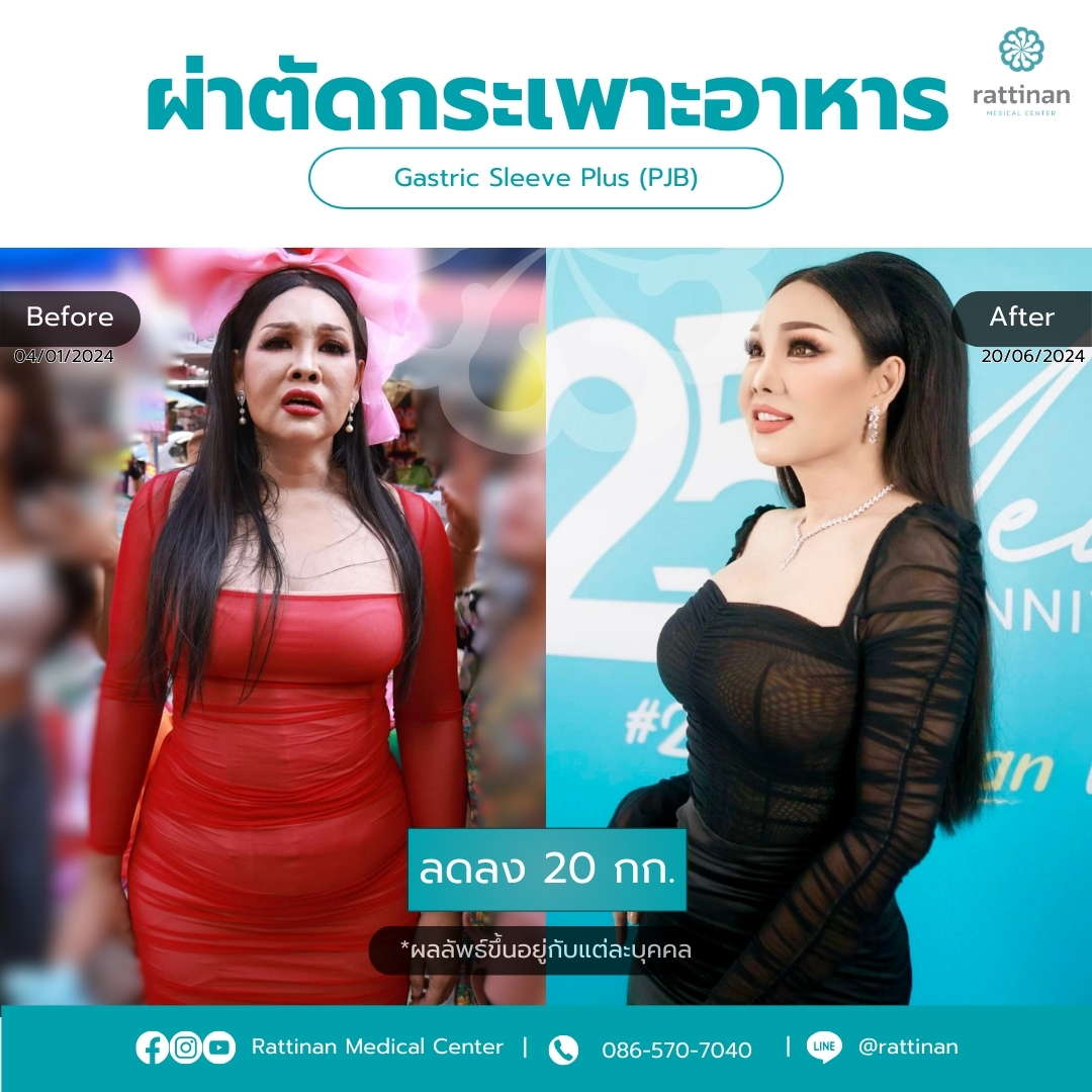 ผ่าตัดกระเพาะ รีวิว Gastric sleeve plus PJB Before & After