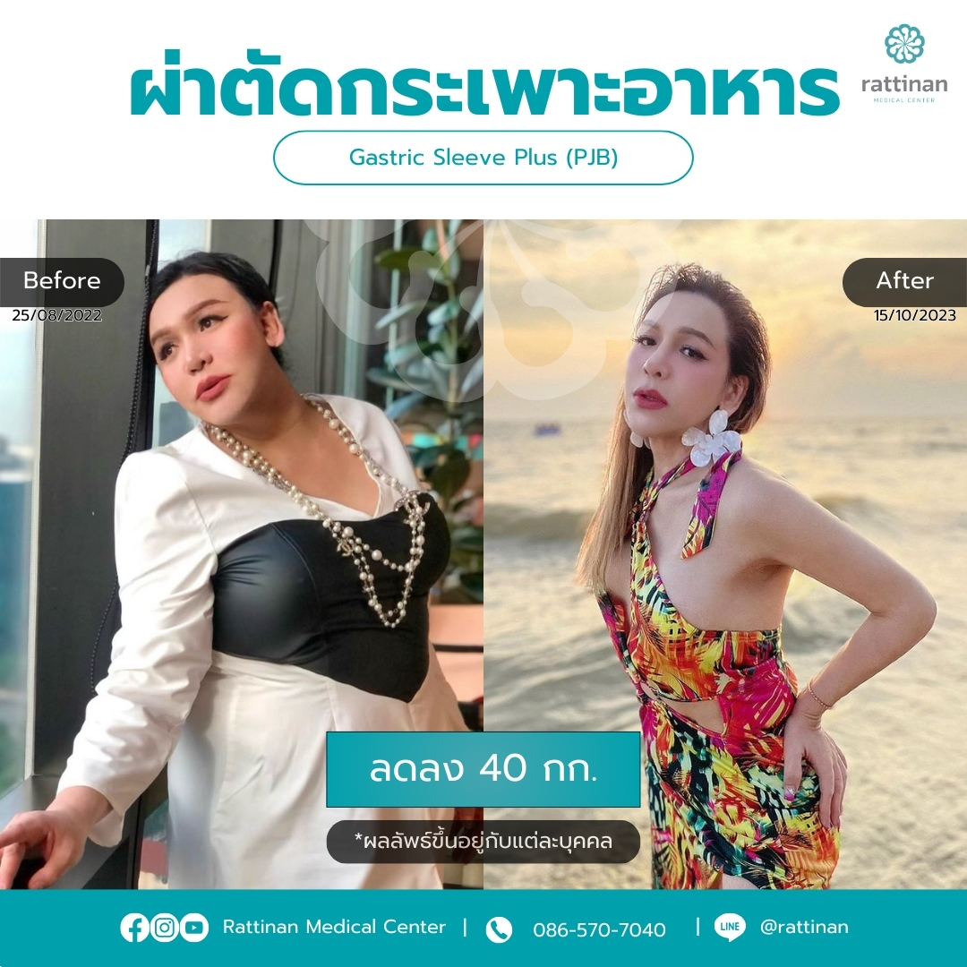 ผ่าตัดกระเพาะ รีวิว Gastric sleeve plus PJB Before & After 02