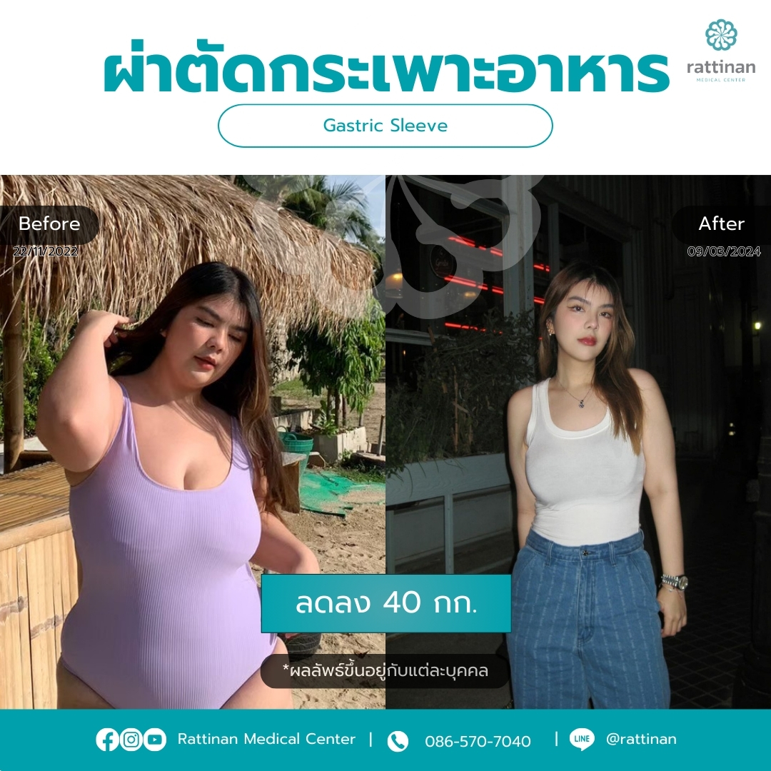 ผ่าตัดกระเพาะ Before & After รัตตินันท์