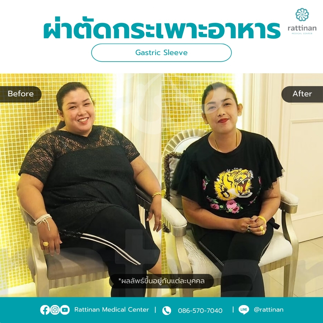 ผ่าตัดกระเพาะ รีวิว Gastric sleeve Before & After 06