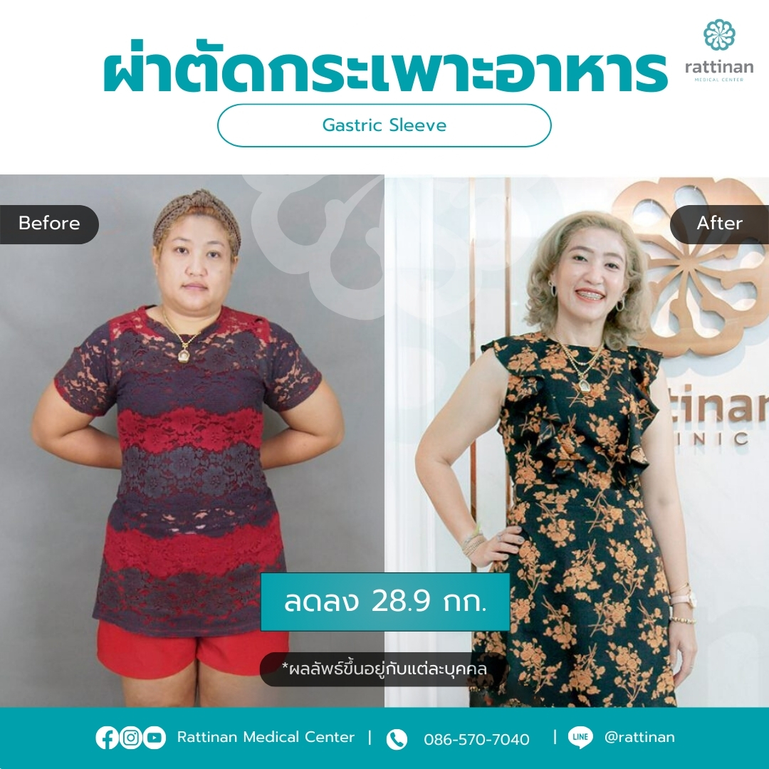 ผ่าตัดกระเพาะ รีวิว Gastric sleeve Before & After 05