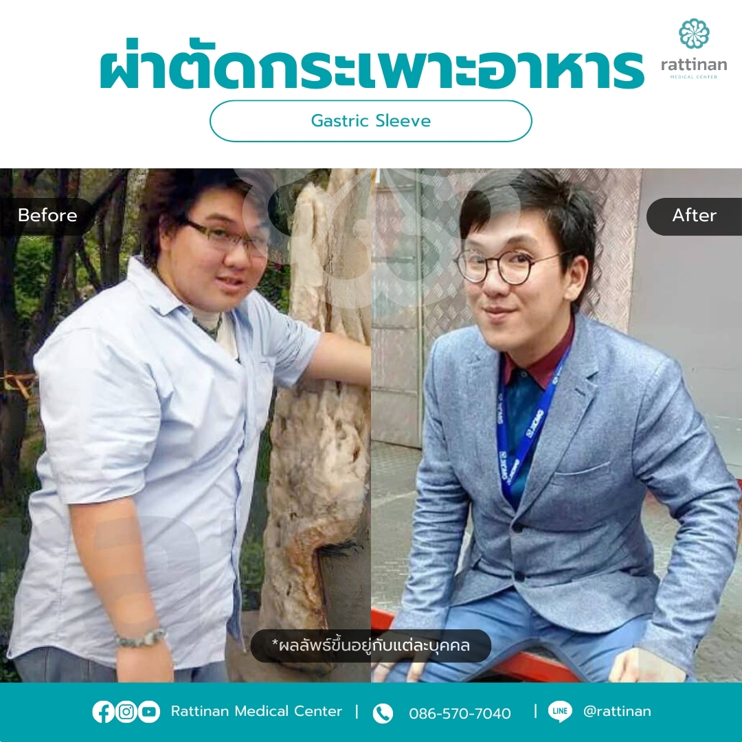 ผ่าตัดกระเพาะ รีวิว Gastric sleeve Before & After 04