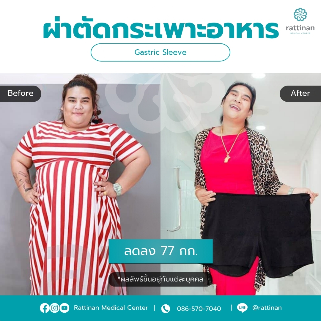 ผ่าตัดกระเพาะ รีวิว Gastric sleeve Before & After 03