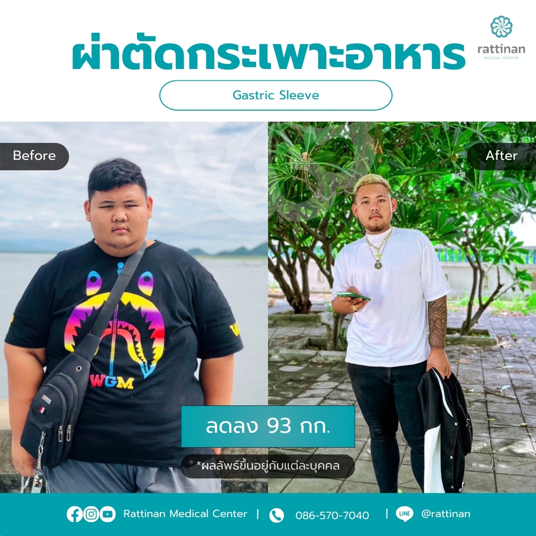 ผ่าตัดกระเพาะ รีวิว Gastric sleeve Before & After 02