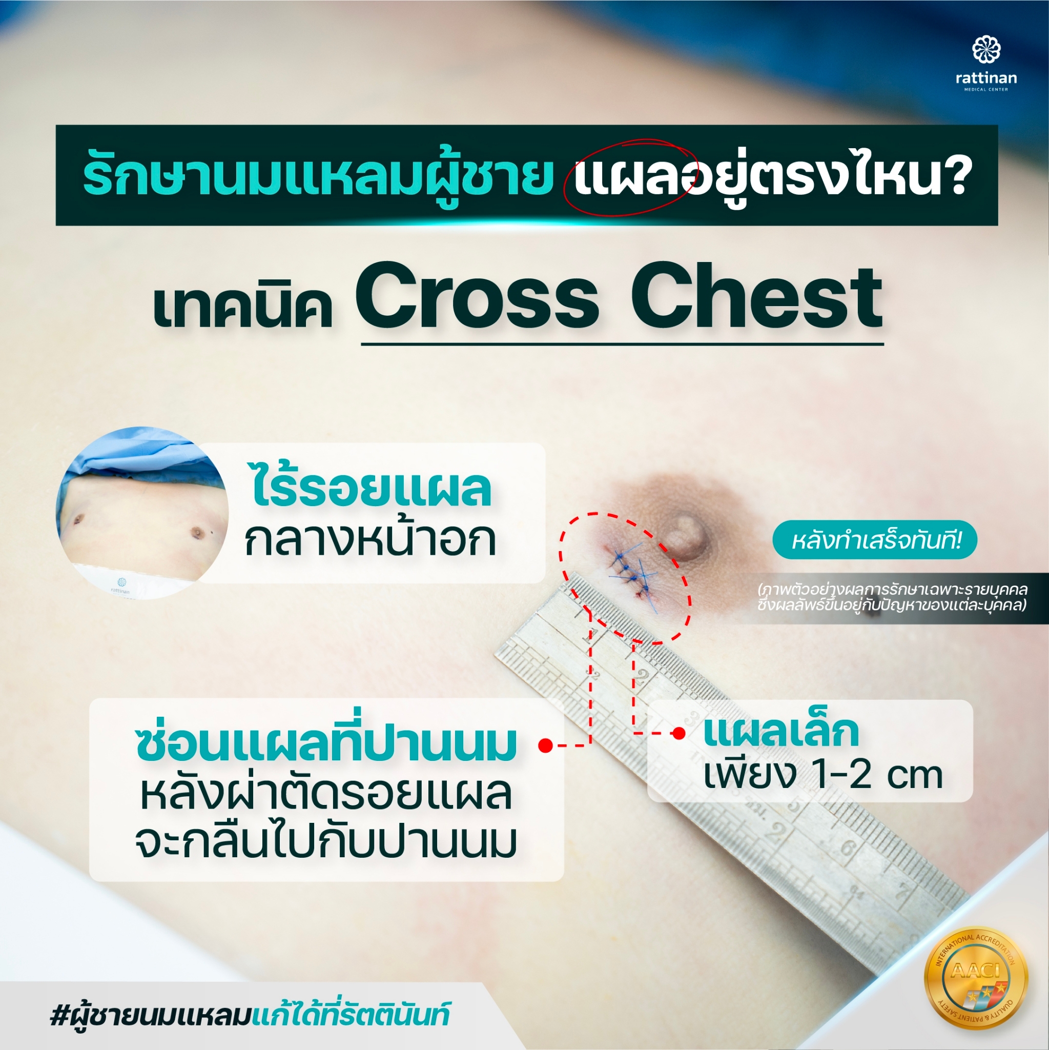 gynecomastia ราคา เทคนิค