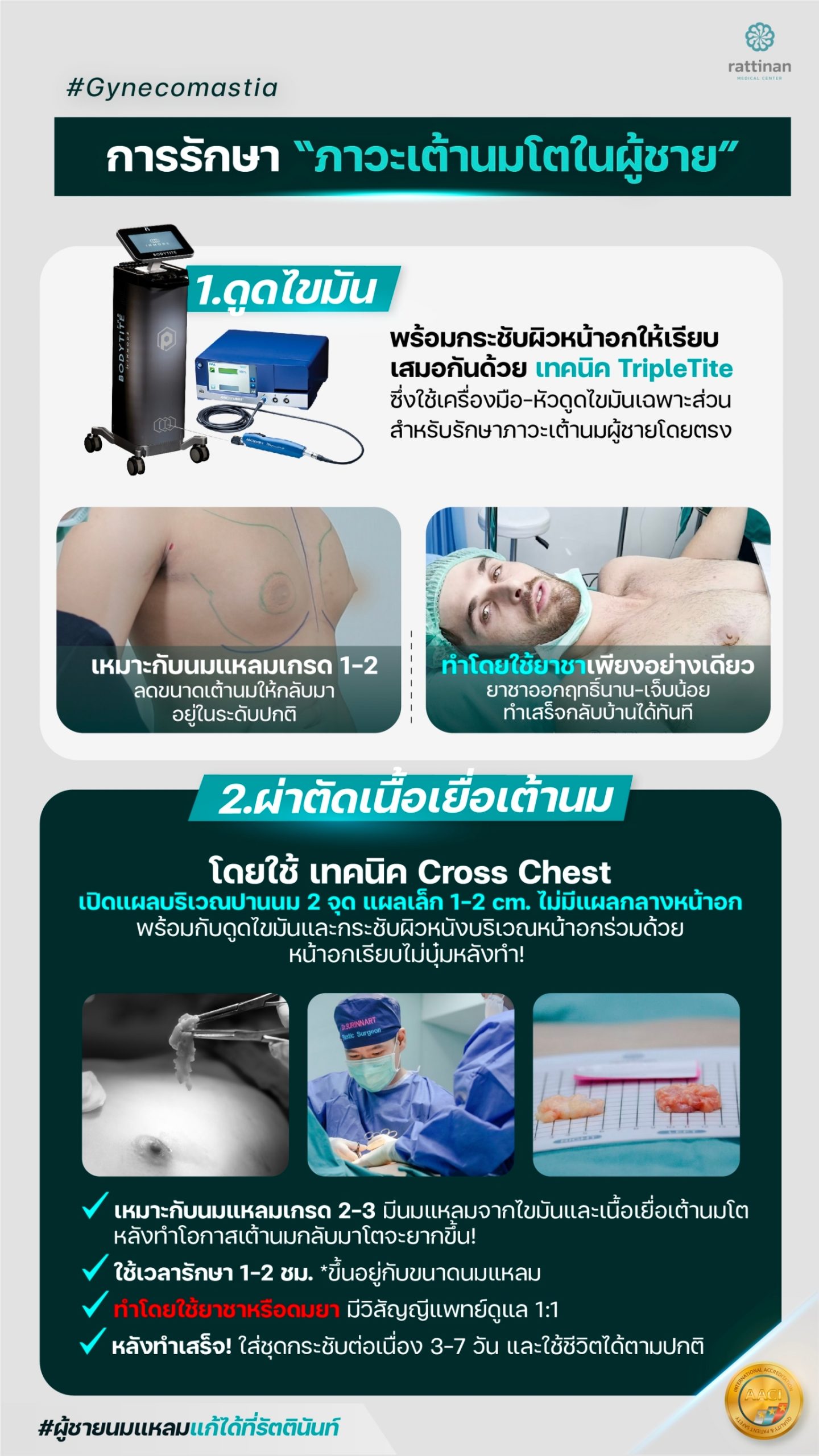 gynecomastia ราคา วิธีการรักษา