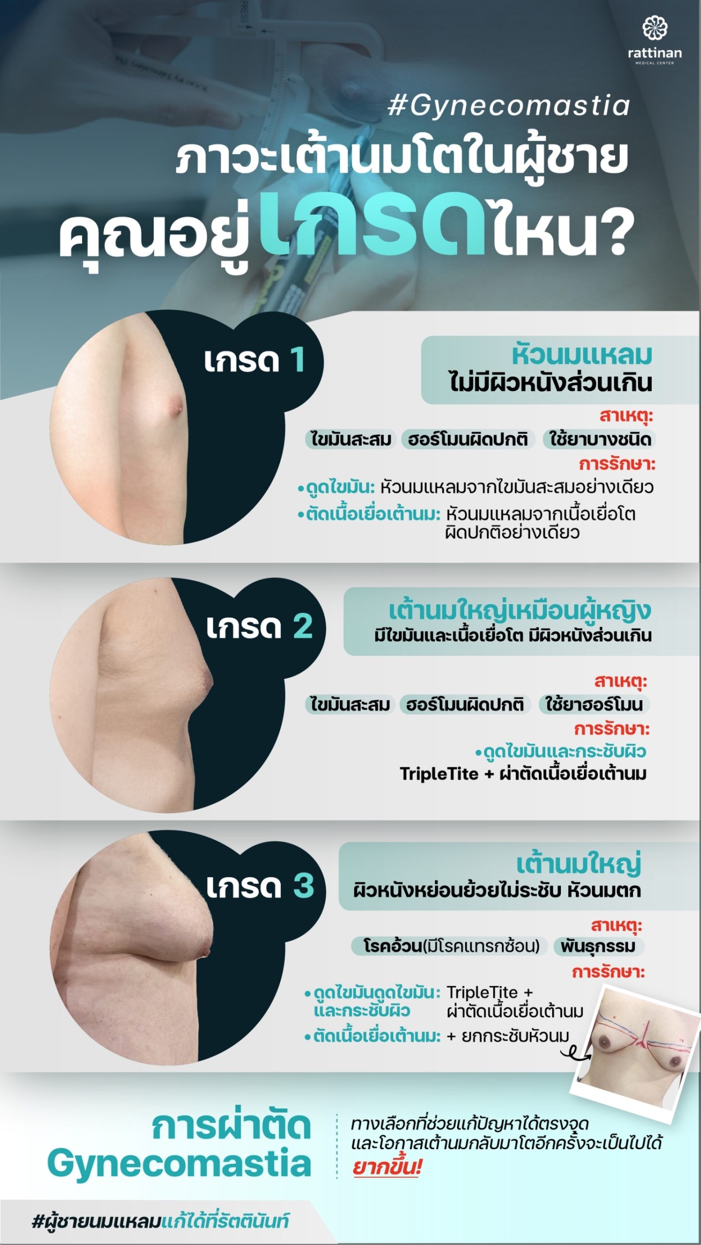 gynecomastia ราคา แบ่งตามเกรด