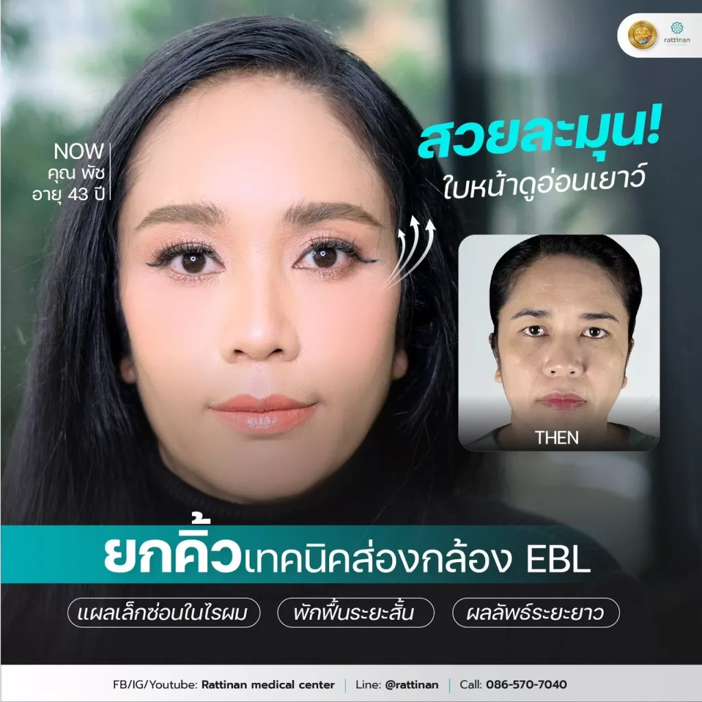 รีวิวยกคิ้วส่องกล้อง รัตตินันท์ เมดิคอล เซ็นเตอร์