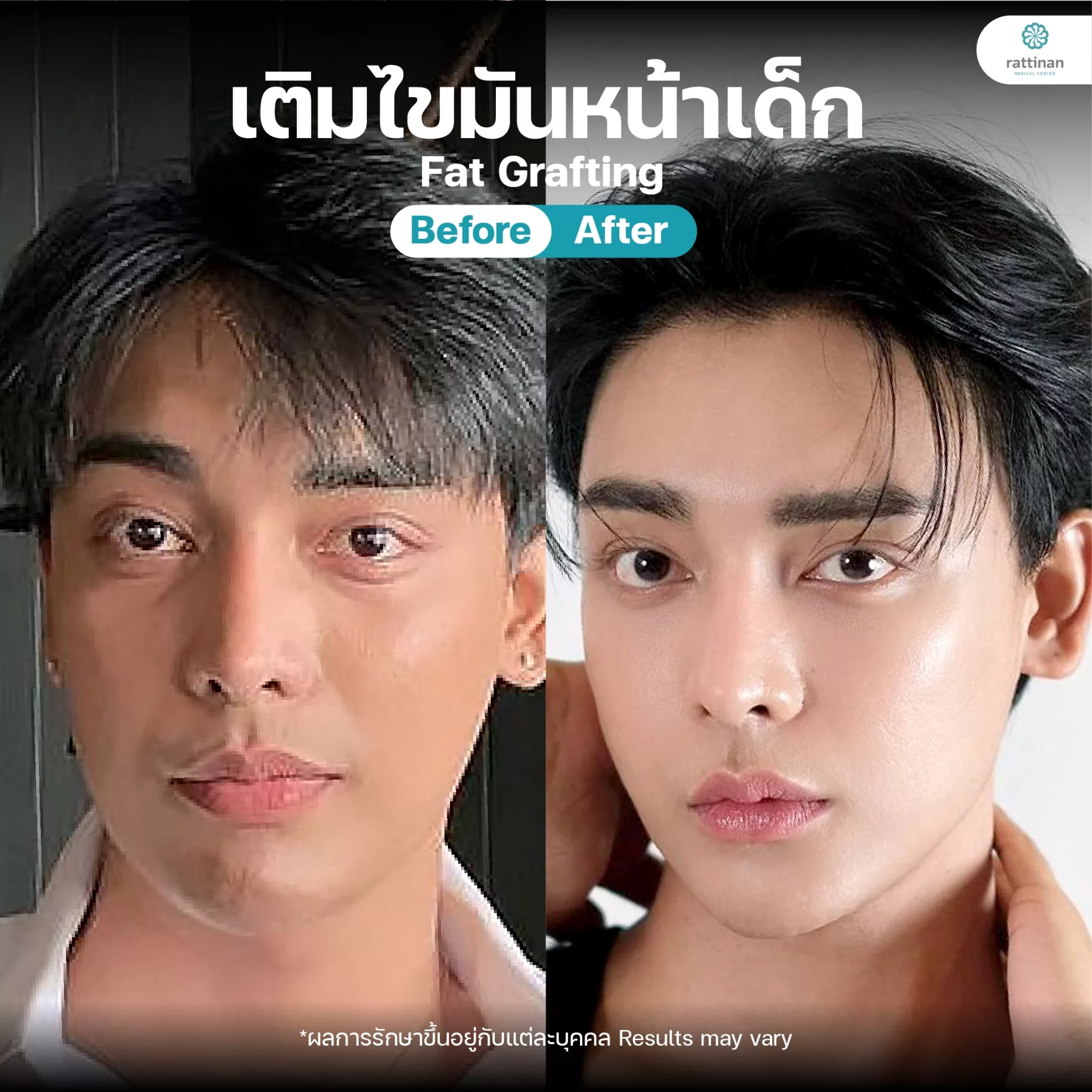 เติมไขมันผู้ชาย รีวิว