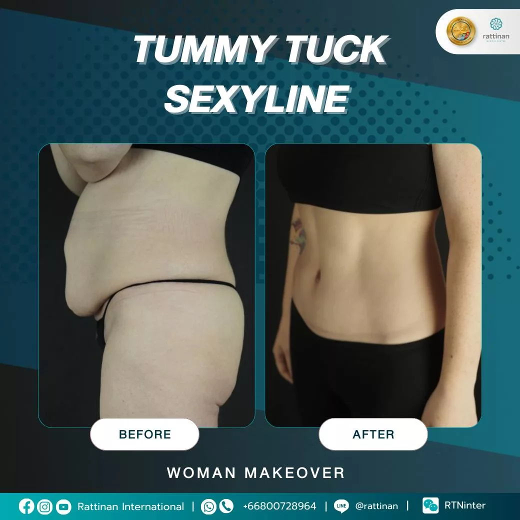 รีวิว Tummy Tuck ตัดหนังหน้าท้อง 1