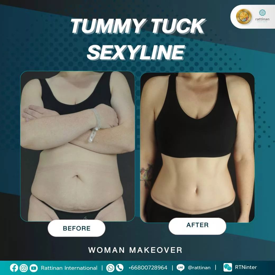 รีวิว Tummy Tuck ตัดหนังหน้าท้อง 3