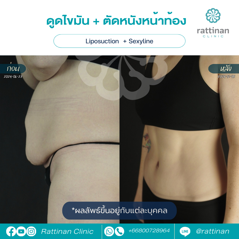 รีวิว Tummy Tuck ตัดหนังหน้าท้อง 01